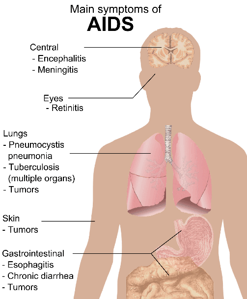 AIDS Symptoms SimpleMed