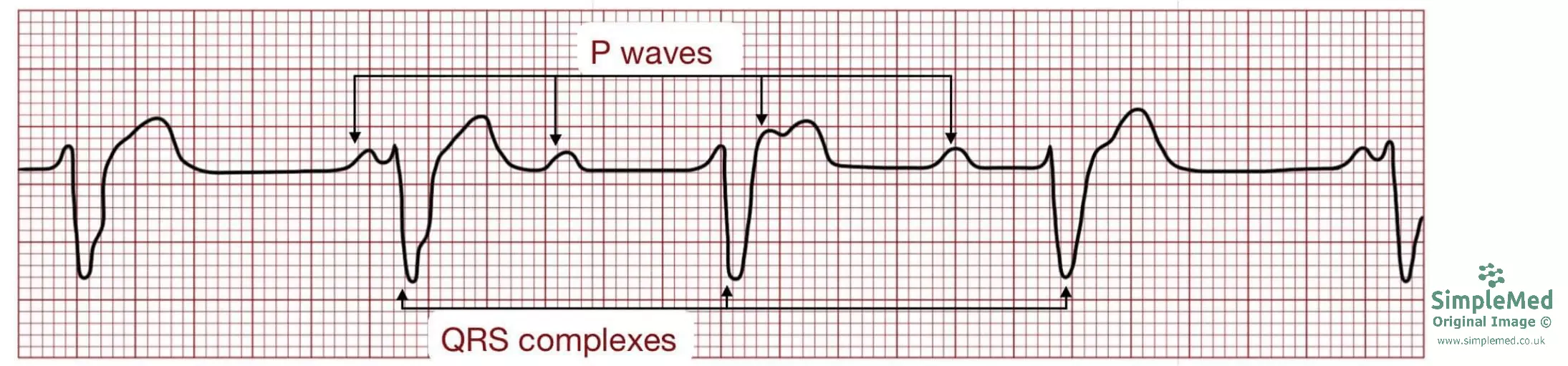 Third Degree heart block ECG SimpleMed