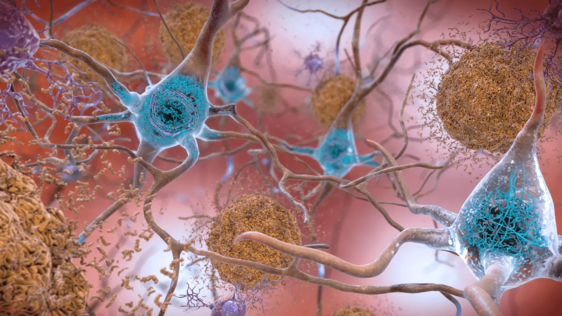 Beta-amyloid and Tau Proteins in Alzheimer's Disease SimpleMed