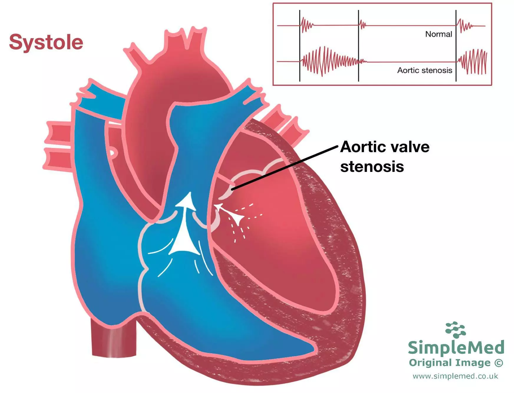 Aortic Valve Stenosis SimpleMed