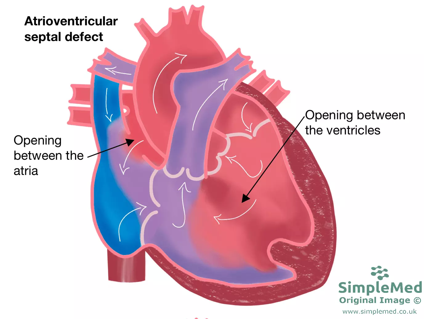 Atrioventricular Septal Heart Defect SimpleMed