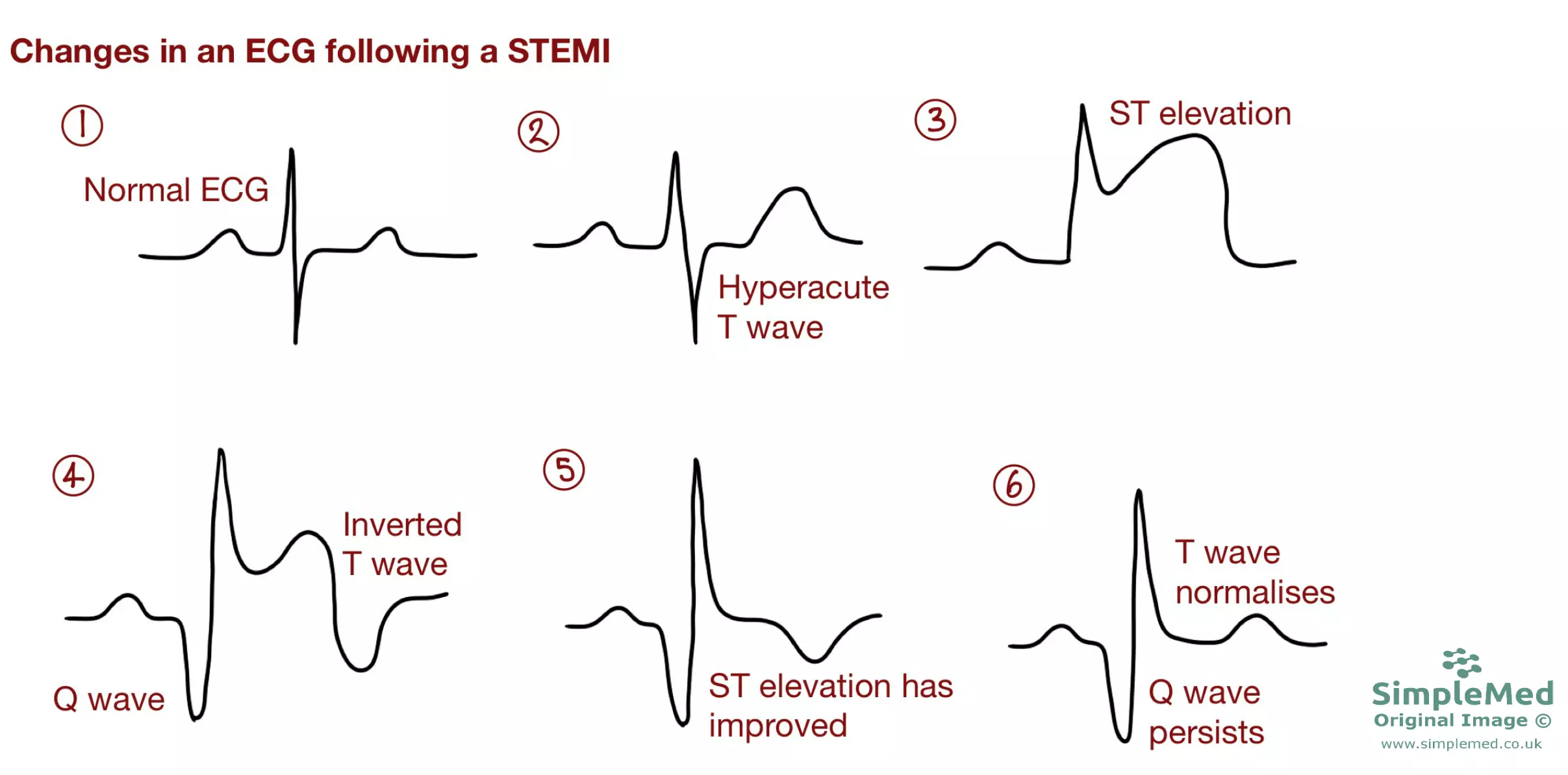 ECG changes in a STEMI over time SimpleMed