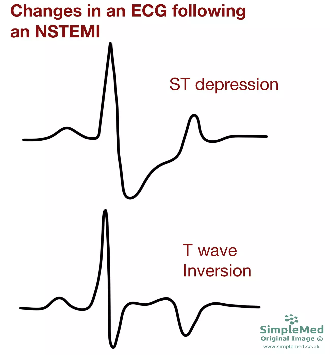 ECG changes in an NSTEMI SimpleMed