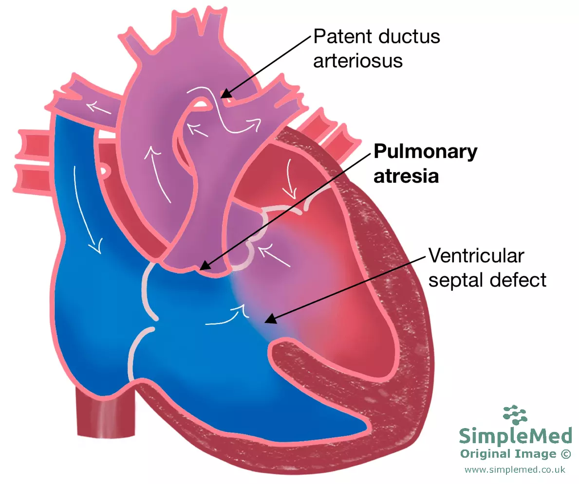 Pulmonary Atresia with Ventricular Septal Defect SimpleMed