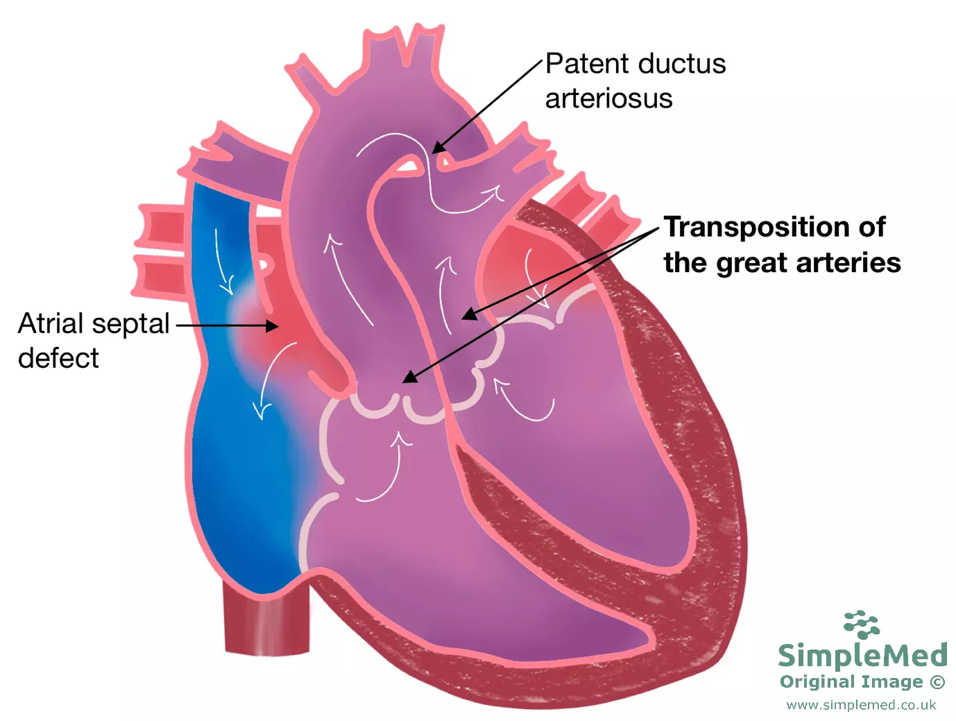Transposition of the Great Arteries SimpleMed