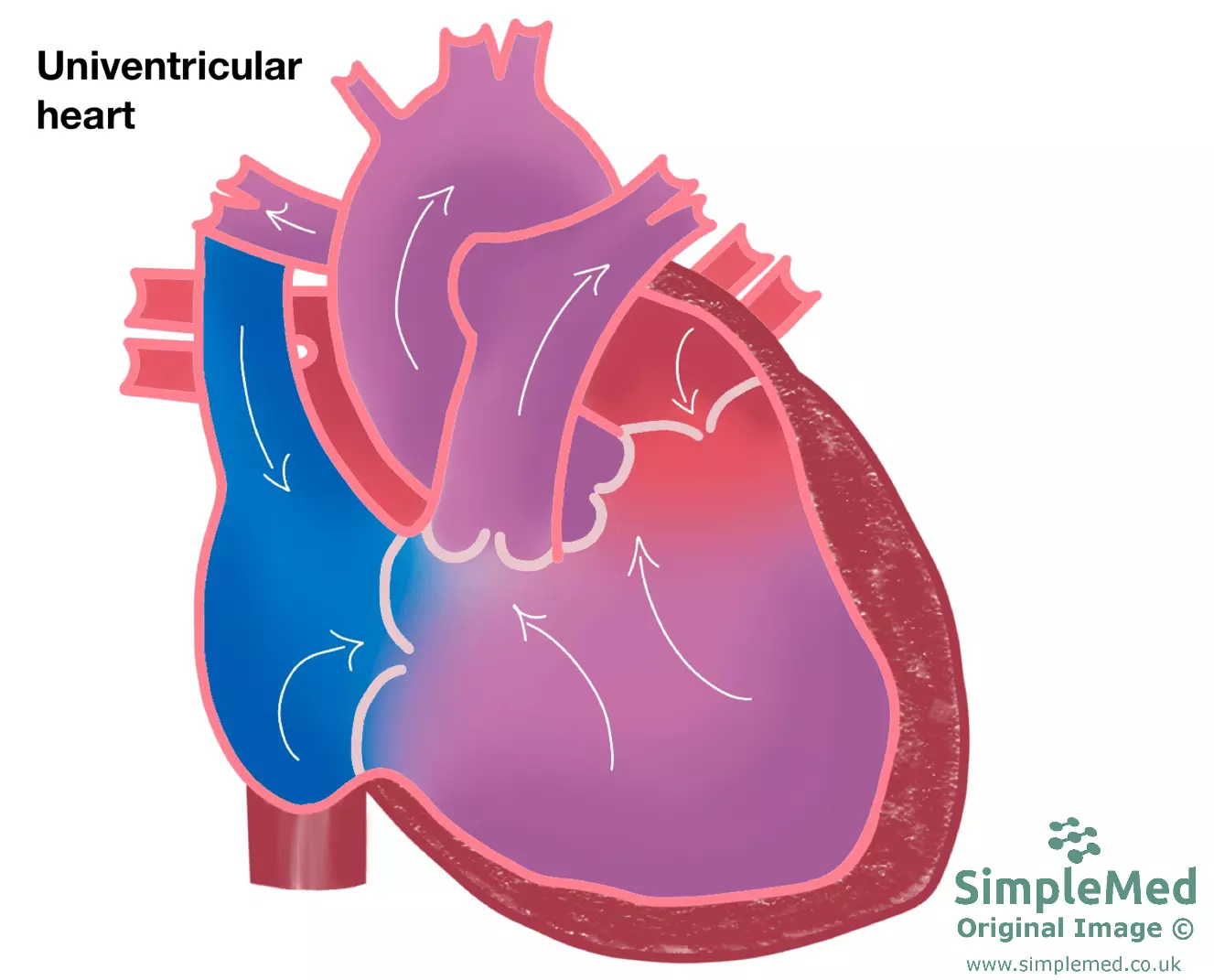 Univentricular Left Heart SimpleMed