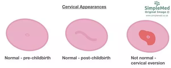 Cervical Appearances SimpleMed