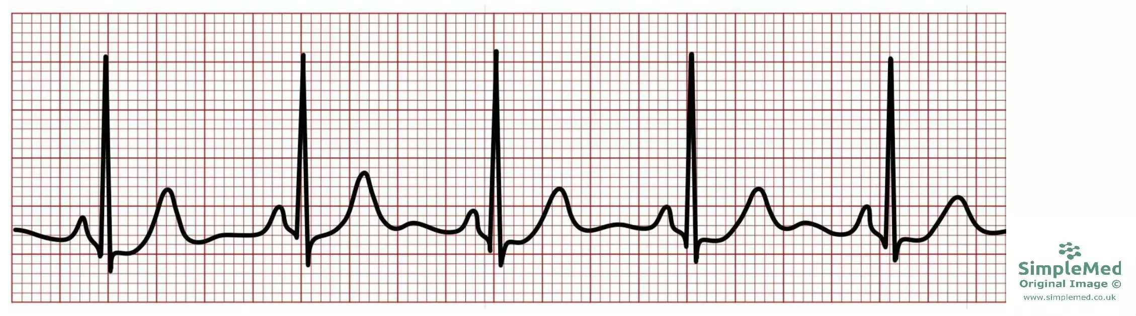 Normal Electrocardiogram ECG SimpleMed
