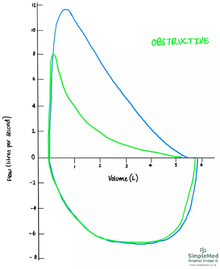 Obstructive Flow Volume Curve SimpleMed