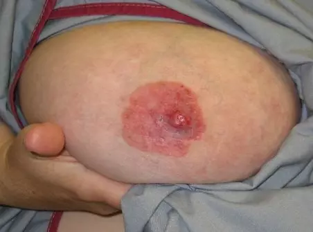 Paget's Disease of the Nipple SimpleMed