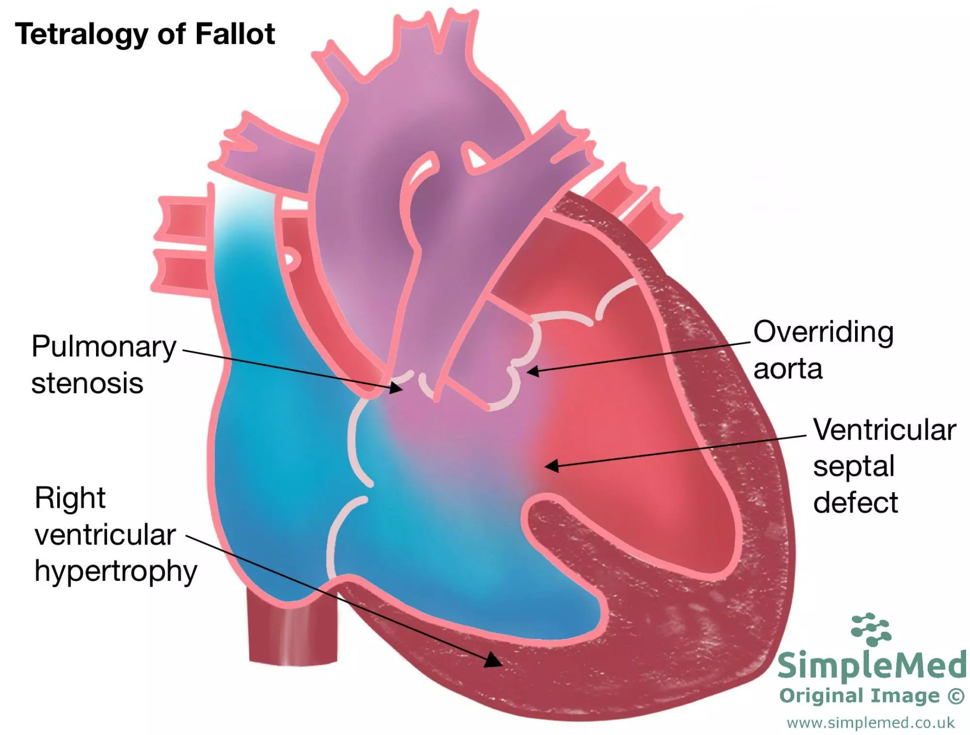 Tetralogy of fallot congenital heart defect SimpleMed