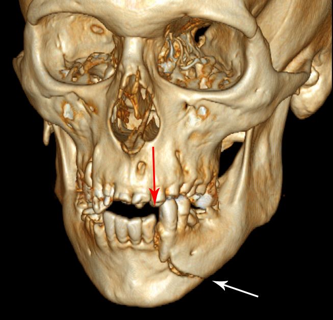 3D CT Mandible Fracture SimpleMed