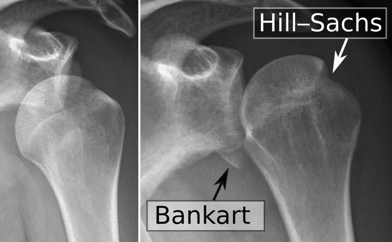 Shoulder Dislocation with Bankart lesion and Hill-sachs lesion SimpleMed