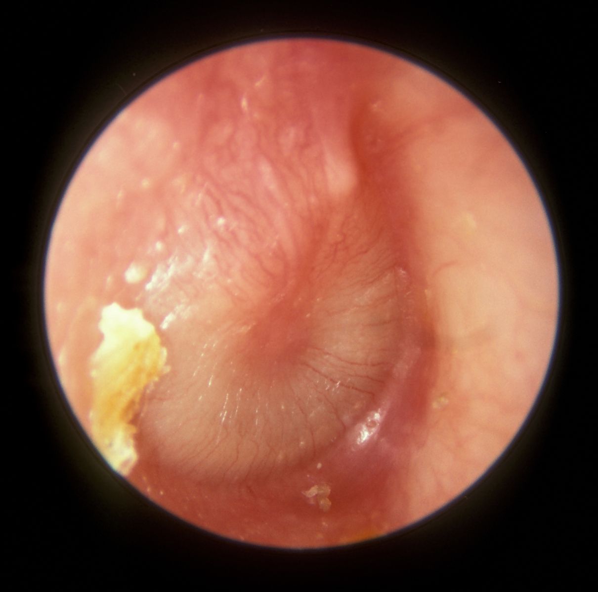 Acute Otitis Media SimpleMed Acute Otitis Media SimpleMed