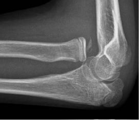 Anterior Elbow Dislocation X-Ray SimpleMed