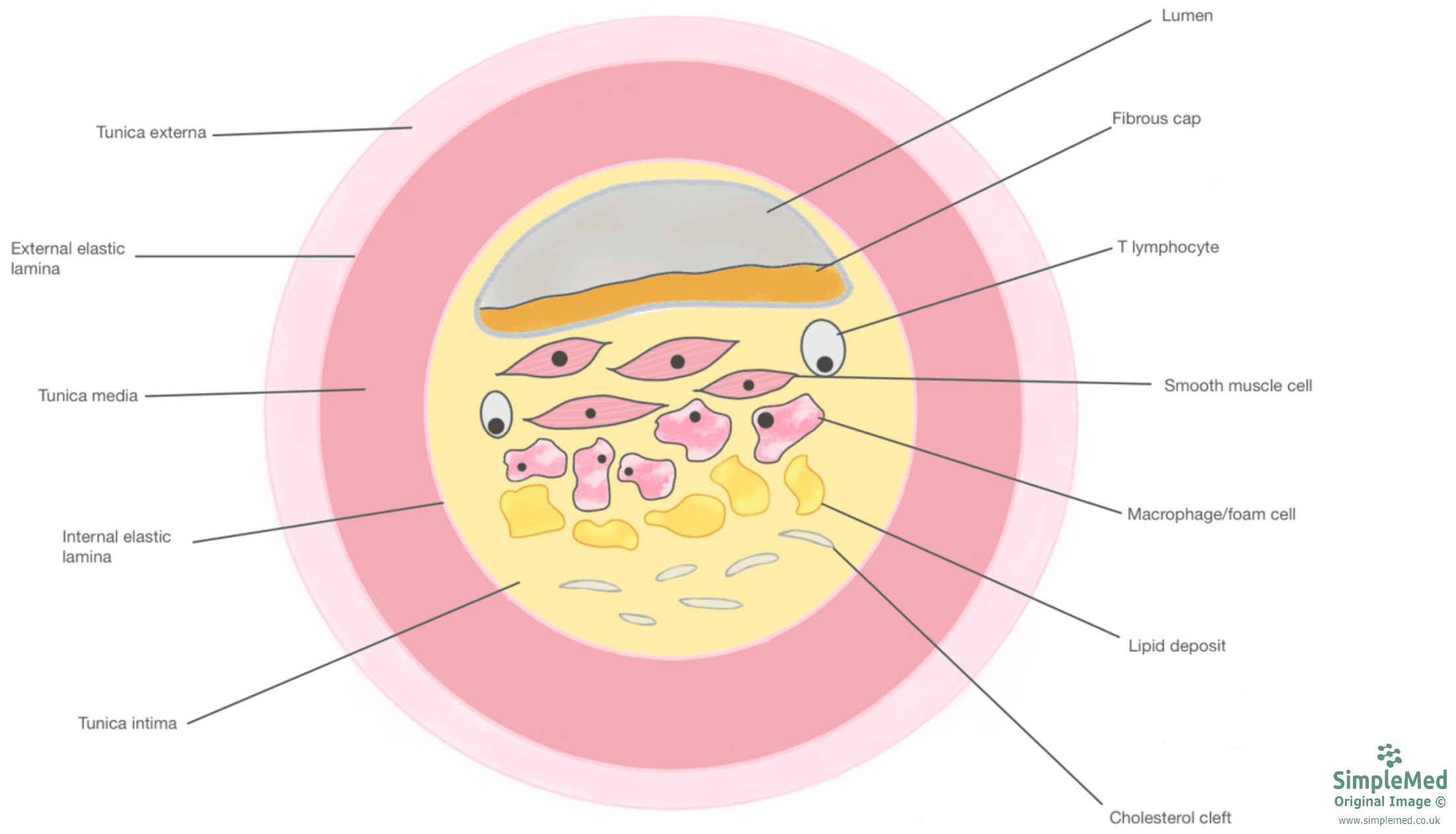 Atherosclerotic Plaque Diagram SimpleMed