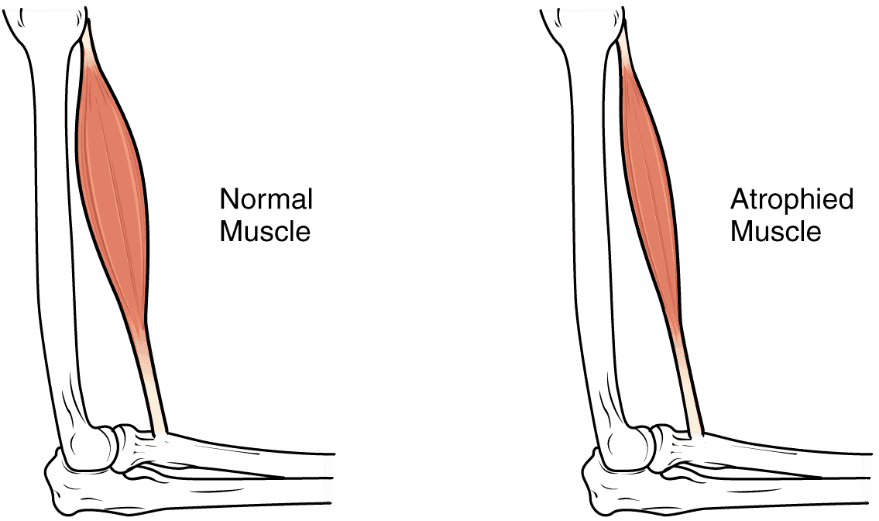 Atrophy Diagram Showing Muscle Atrophy SimpleMed