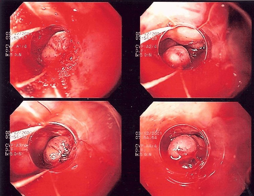 Band Ligation of Oesophageal Varices SimpleMed Band Ligation of Oesophageal Varices SimpleMed