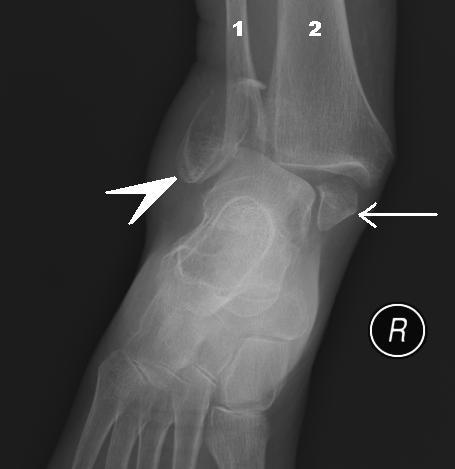 Bimalleolar Fracture X-Ray Medial and Lateral Malleolus Fractures SimpleMed