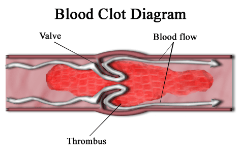Bloot Clot in a Vein SimpleMed