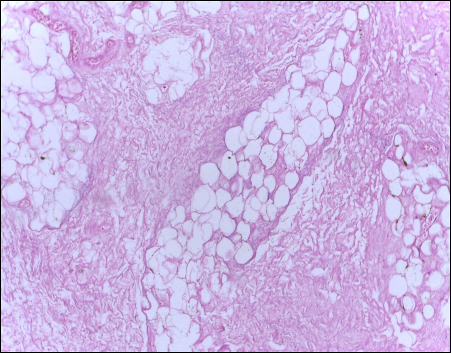 Fat Necrosis of Breast Tissue SimpleMed