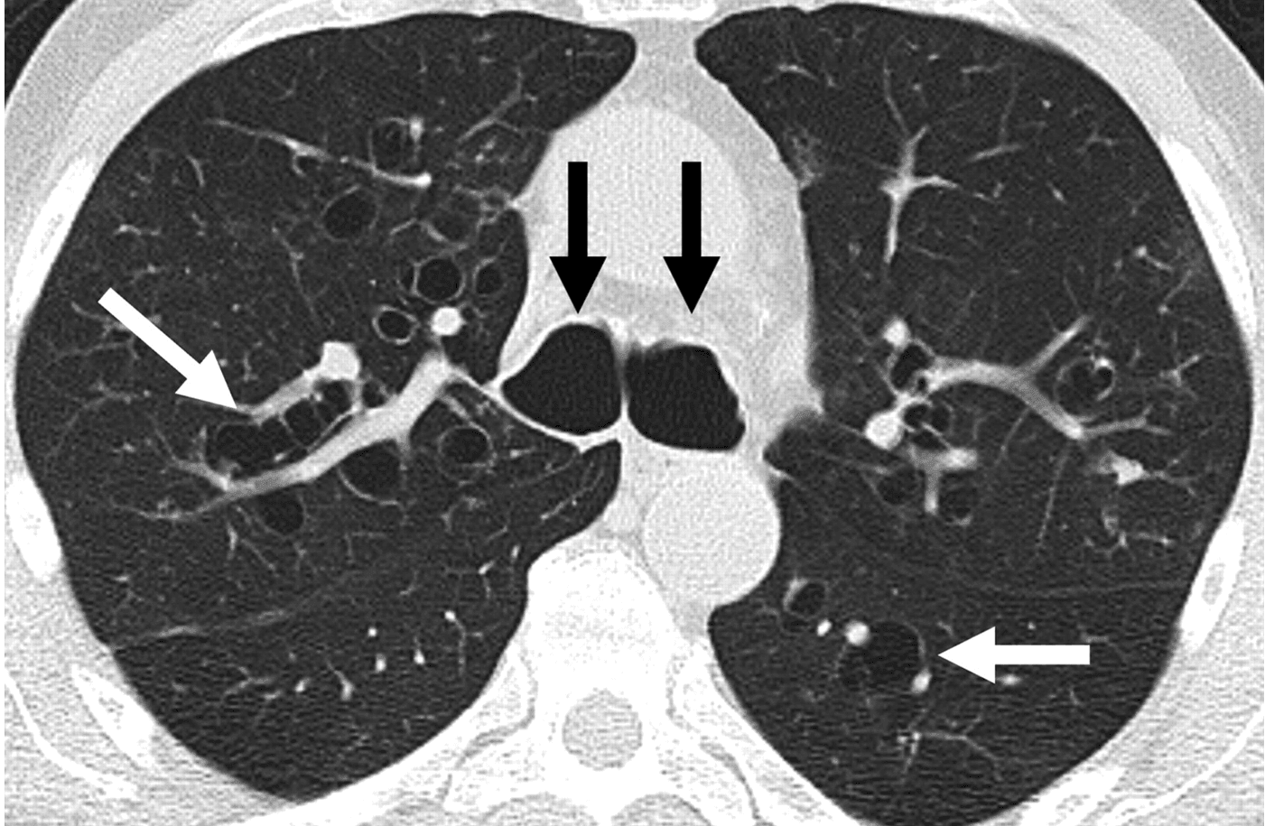 Bronchiectasis CT Scan SimpleMed