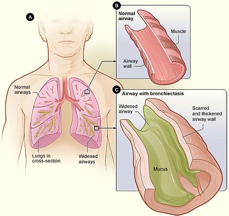 Bronchiectasis vs Normal Lung SimpleMed