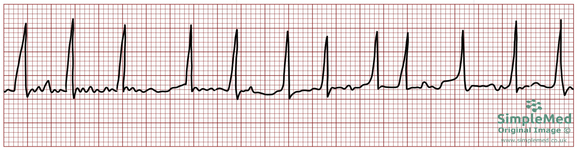Atrial Fibrillation Electrocardiogram ECG SimpleMed