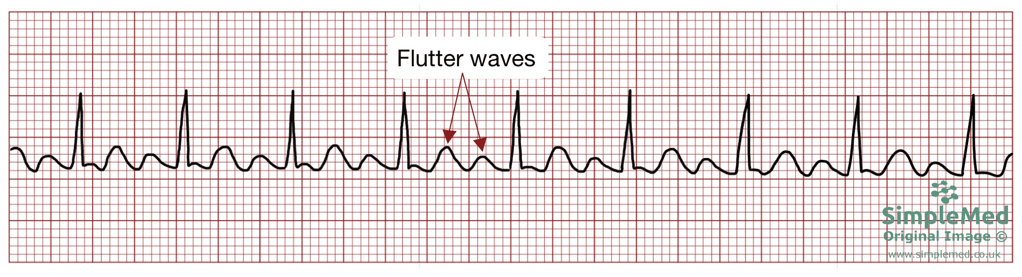 Atrial Flutter ECG electrocardiogram pathology SimpleMed