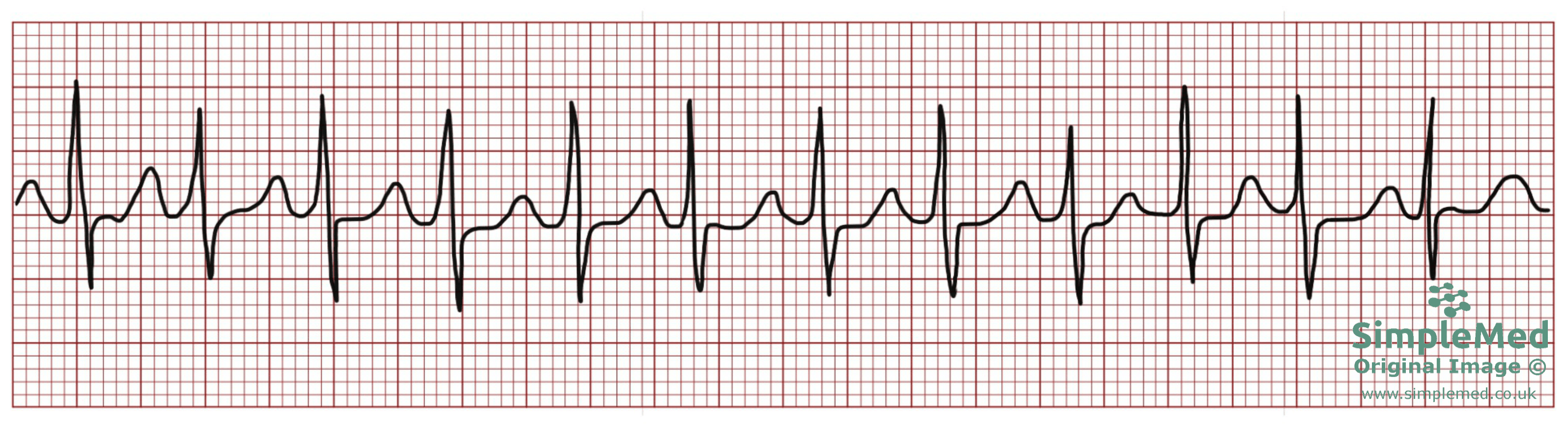 Atrial Tachycardia ECG electrocardiogram pathology SimpleMed