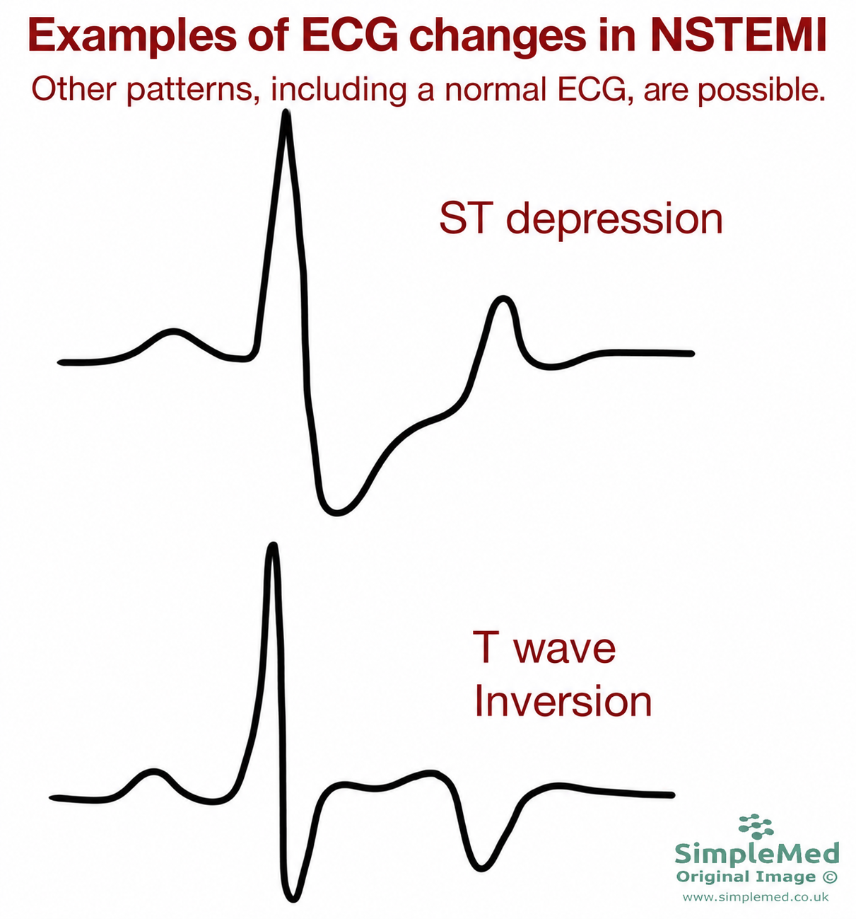 Two illustrative ECG tracings showing ST depression and T wave inversion in NSTEMI; other patterns, including a normal ECG, are possible.