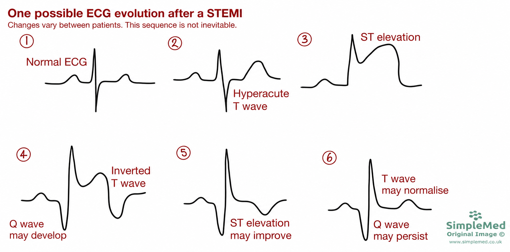 Six illustrative ECG panels: normal tracing, hyperacute T wave, ST elevation, possible Q wave and T inversion, improving ST elevation, and possible T normalisation with a persisting Q wave. This sequence is not inevitable.
