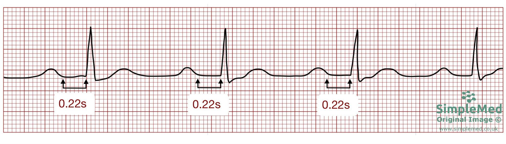 First degree heart block ECG SimpleMed