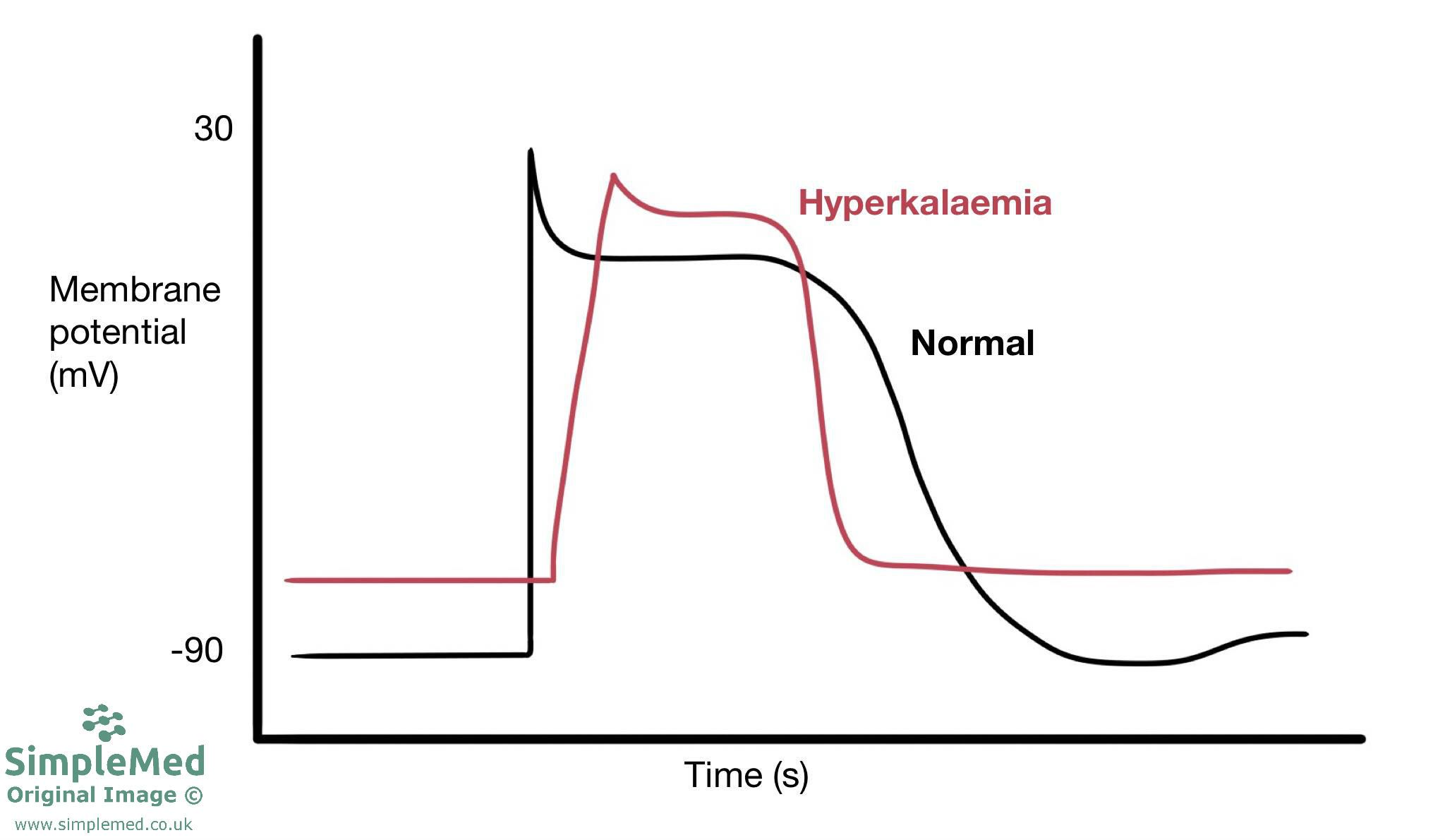 Hyperkalaemia Action Potential SimpleMed