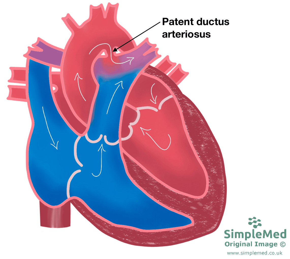 Patent Ductus Arteriosus SimpleMed