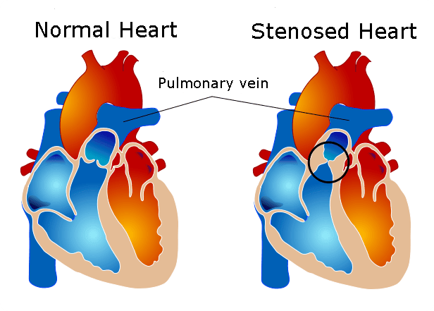 Pulmonary Valve Stenosis SimpleMed