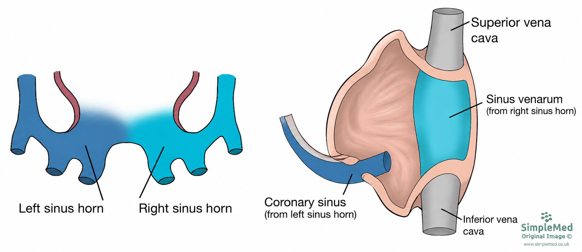Right sinus horn and sinus venarum The right sinus horn forms the smooth right atrial sinus venarum; separate grey superior and inferior vena cava enter the atrium.