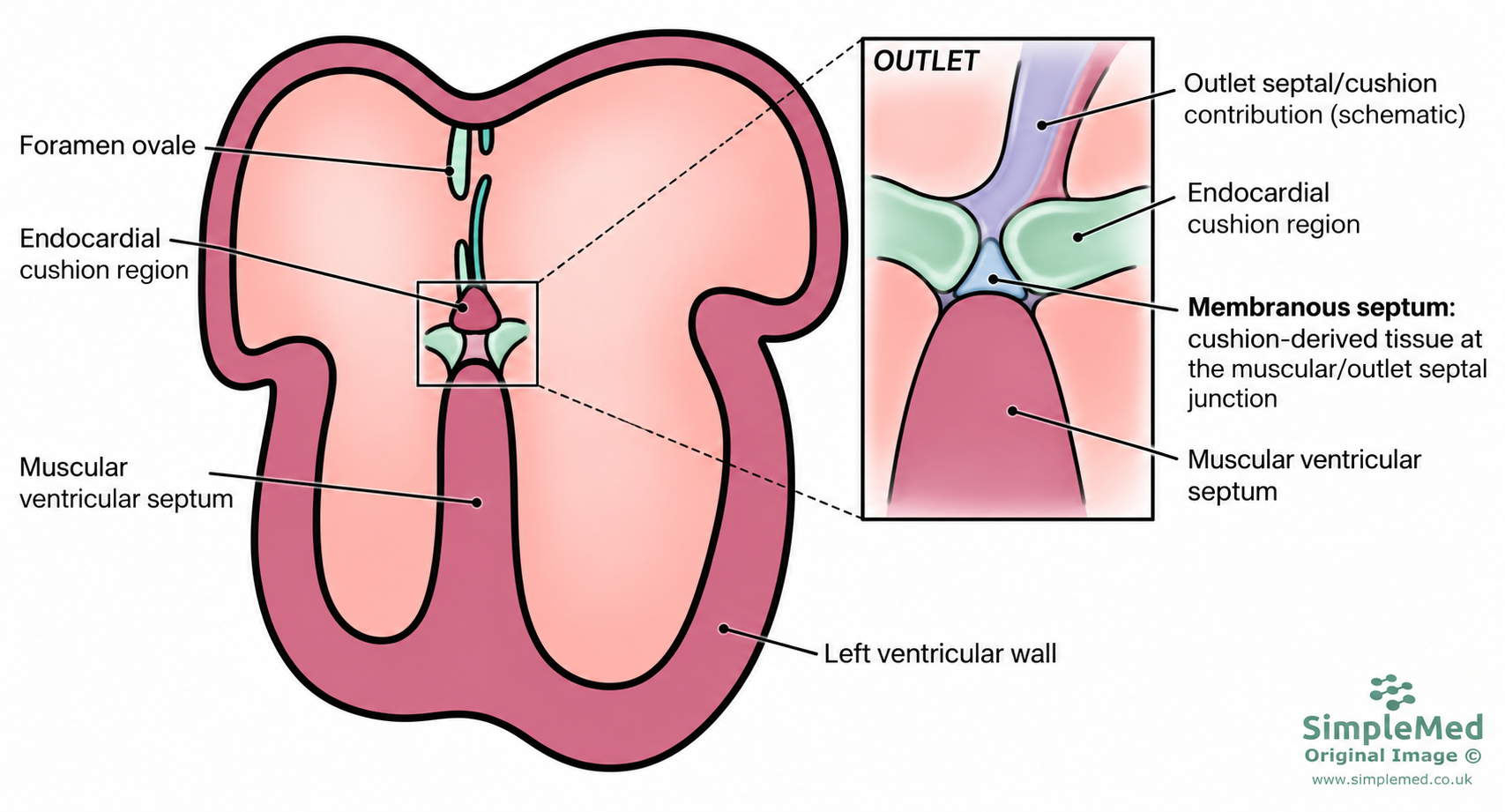 A small cushion-derived membranous septum joins the muscular ventricular septum, endocardial cushion region and outlet septal contribution.