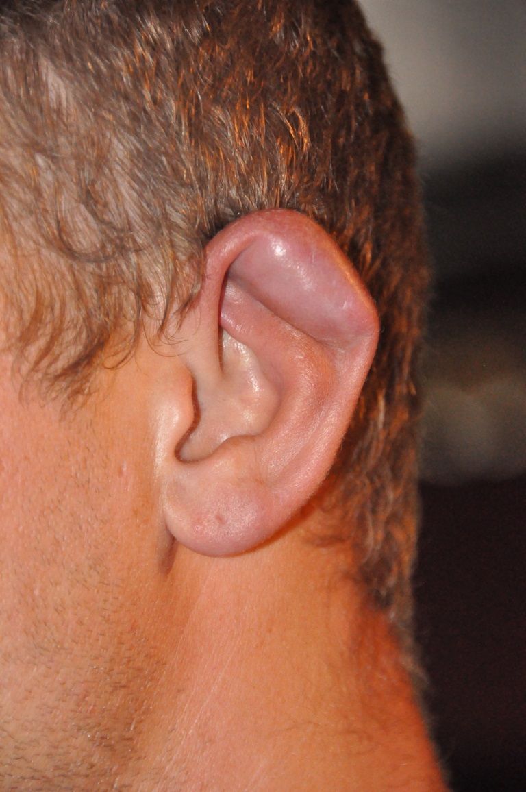 Caulifower Ear Deformity SimpleMed Caulifower Ear Deformity SimpleMed