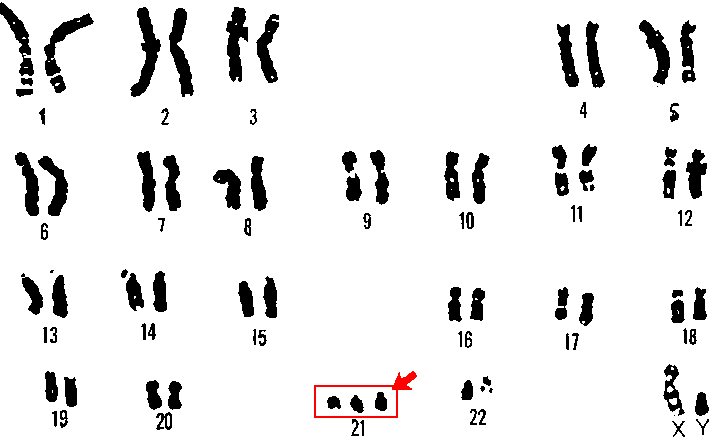 Male Karyotype with Trisomy 21/Down's Syndrome SimpleMed