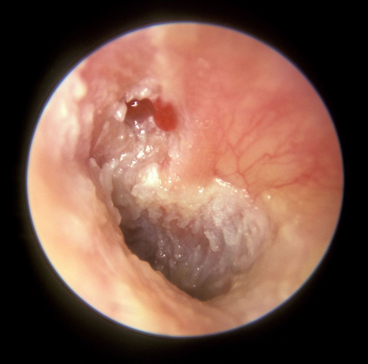 Cholesteatoma SimpleMed Cholesteatoma SimpleMed