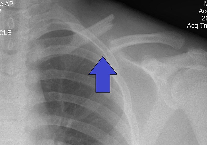 Mid-Clavicular Fracture X-ray SimpleMed