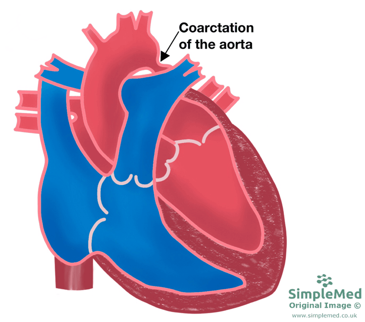 Coarctation of the Aorta SimpleMed