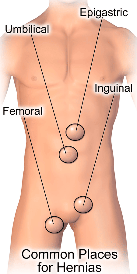 Common Sites of Hernias SimpleMed