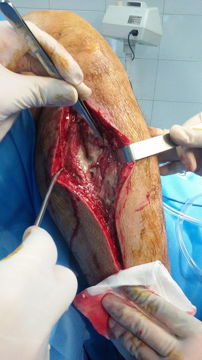 Compartment Syndrome with Fasciotomy Procedure SimpleMed
