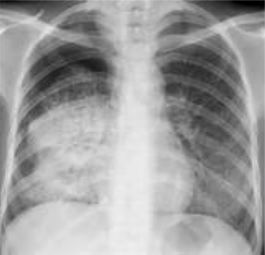 Primary Pulmonary Tuberculosis on Chest X-ray SimpleMed