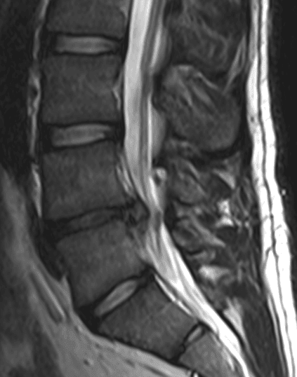 Disc Herniation SimpleMed