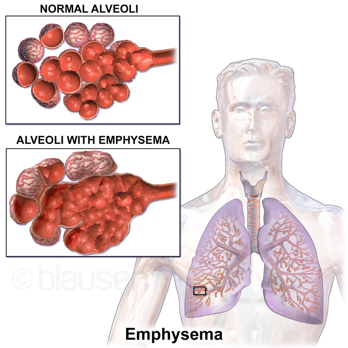 The Effect of Emphysema on the Alveoli SimpleMed