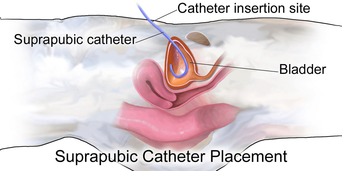 Female Suprapubic Catheter SimpleMed