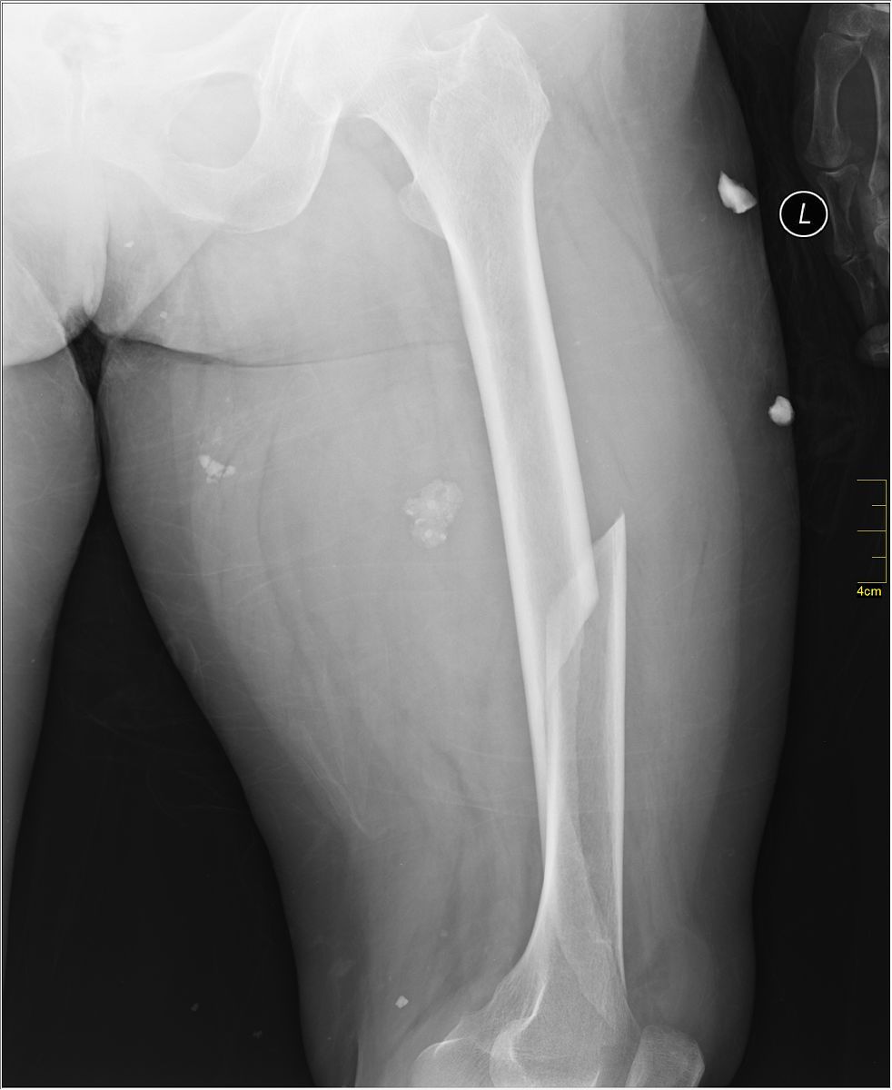 Femoral Shaft Fracture X-ray SimpleMed